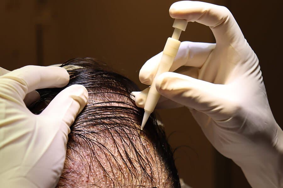 Hair transplant Turkey: Smile Hair Clinic Delivers Excellence