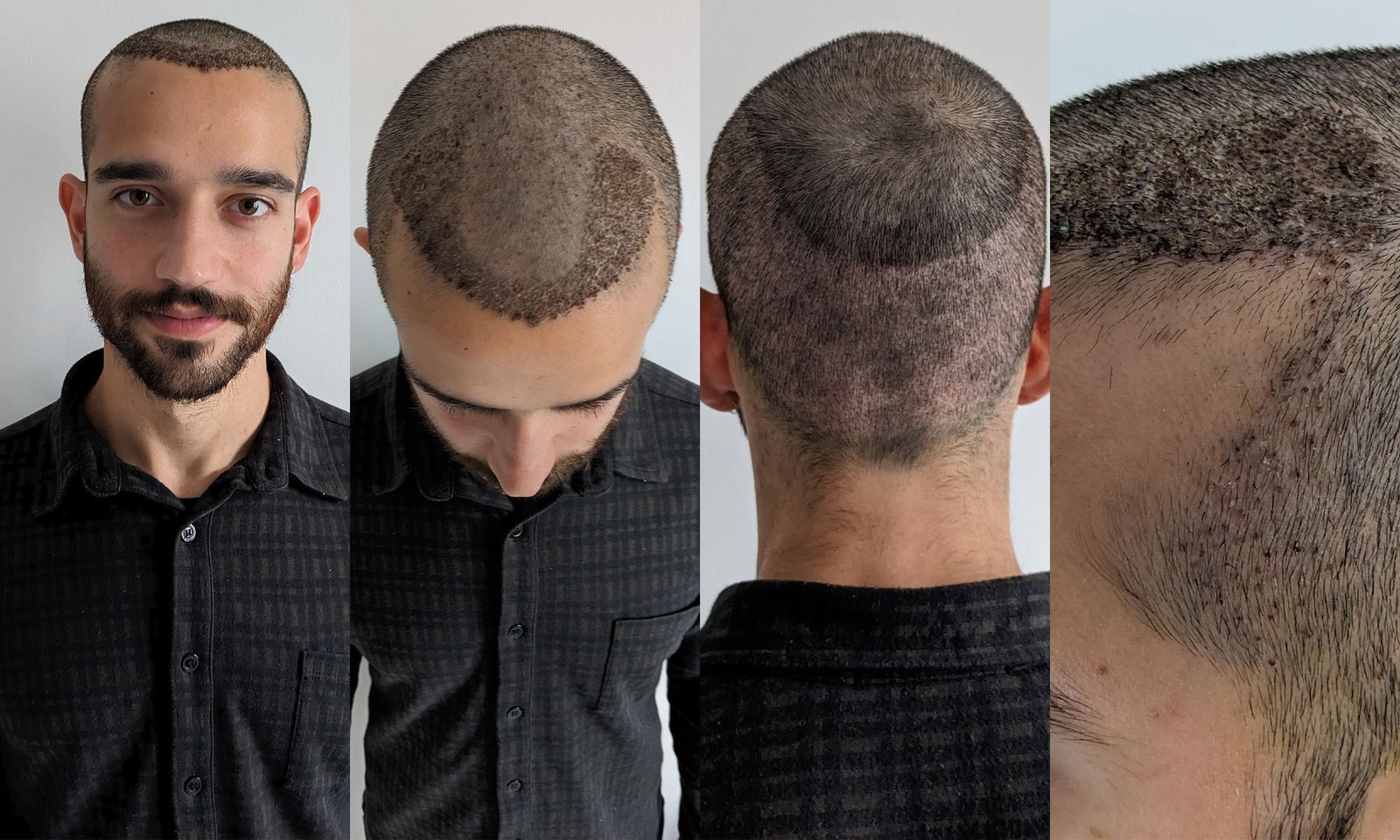 Exclusive Men’s Hair Replacement NYC Studio